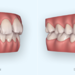 Invisalign-Outcome-Simulator-Screenshotaufm