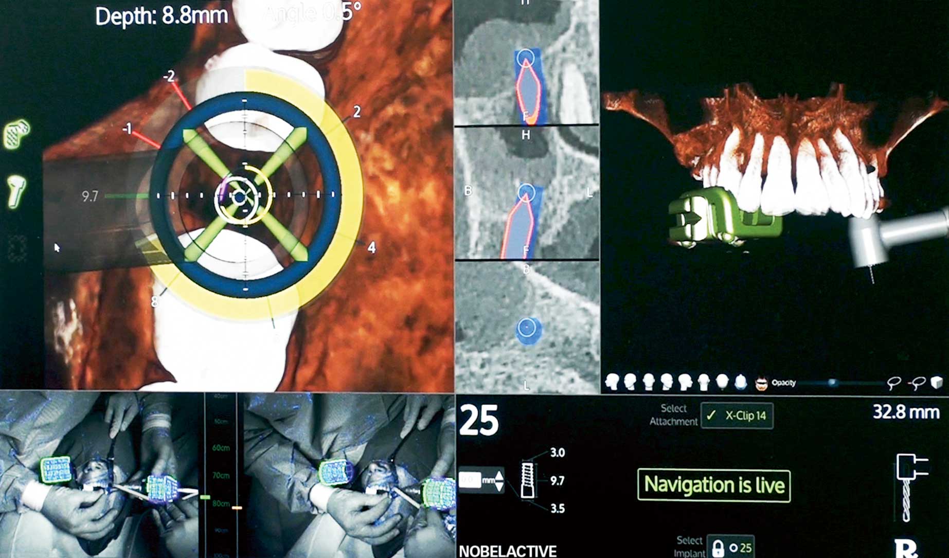XGuide Chirurgisches 3DNavigationssystem dental journal