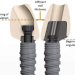 abutments4life (6 von 7)