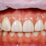 Abb12 Full_mouth