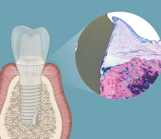 „Periimplantitis lässt sich vermeiden!“