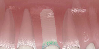 Symbionic Teeth: Der Zahnersatz mit der Schutzbarriere