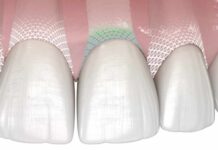 Symbionic Teeth: Zahnersatz mit Schutzbarriere