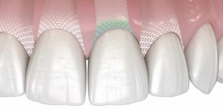 Symbionic Teeth: Zahnersatz mit Schutzbarriere