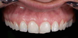 Gestaltung eines „volleren Lächelns“ mit Komposit-Veneers der neuesten Generation