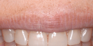 Minimalinvasive Rehabilitation bei generalisiertem Tooth Wear mit konventionellem Komposit und Stempeltechnik