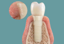 Success Stories Patent Medical: Symbionic Teeth
