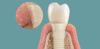 Success Stories Patent Medical: Symbionic Teeth