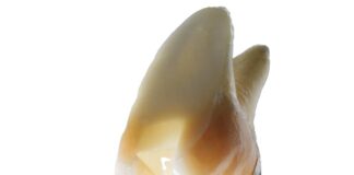 SDR® flow+: bewährt bei Seitenzahnfüllungen